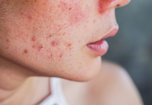 Young woman with acne showing on her face